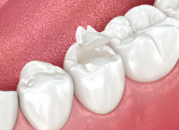 Best Dental Inlays and Onlays  in Webster, SD